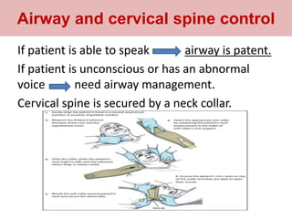 If patient is able to speak airway is patent.
If patient is unconscious or has an abnormal
voice need airway management.
Cervical spine is secured by a neck collar.
Airway and cervical spine control
 