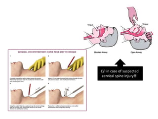 C/I in case of suspected
cervical spine injury!!!
 