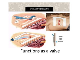 Functions as a valve
 
