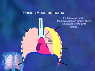Each time we inhale,
the lung collapses further. There
is no place for the air to
escape..
Tension Pneumothorax
 