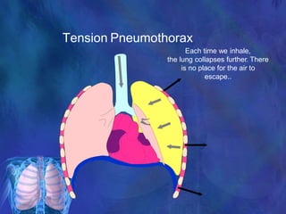 Tension Pneumothorax
Each time we inhale,
the lung collapses further. There
is no place for the air to
escape..
 