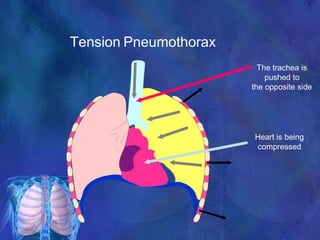 Tension Pneumothorax
Heart is being
compressed
The trachea is
pushed to
the opposite side
 