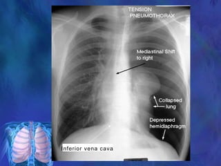 Inferior vena cava
 
