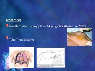 Treatment
Needle Thoracostomy ( 12 or 14 gauge IV catheter in 2nd ICS )
Tube Thoracostomy
 