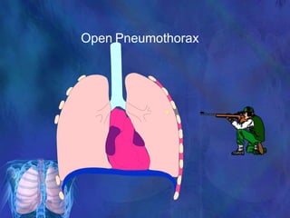 Open Pneumothorax
 