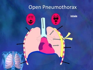 Open Pneumothorax
Inhale
 