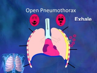 Open Pneumothorax
Exhale
 
