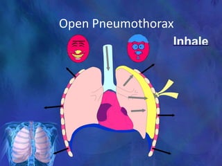Open Pneumothorax
Inhale
 