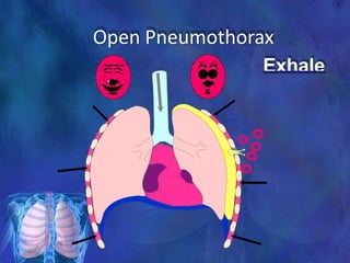 Open Pneumothorax
Exhale
 