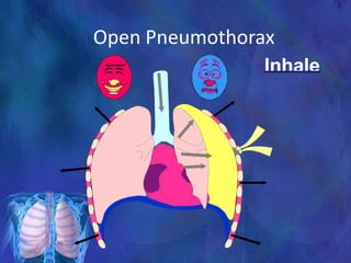 Open Pneumothorax
Inhale
 