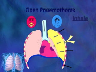 Open Pnuemothorax
Inhale
 