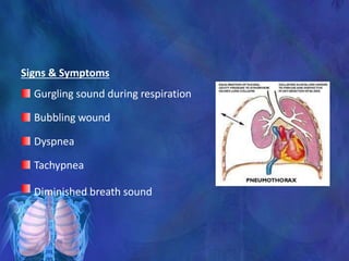 Signs & Symptoms
Gurgling sound during respiration
Bubbling wound
Dyspnea
Tachypnea
Diminished breath sound
 