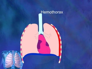 Hemothorax
 