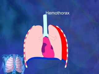 Hemothorax
 
