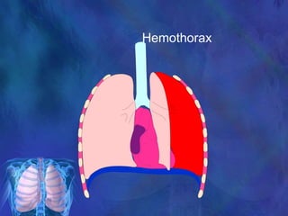 Hemothorax
 