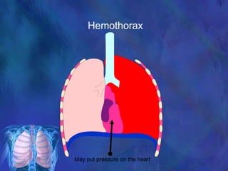 Hemothorax
May put pressure on the heart
 