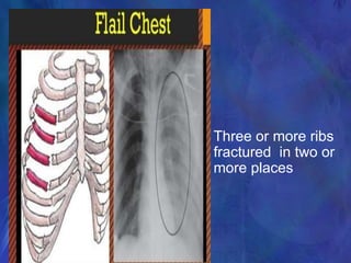 Three or more ribs
fractured in two or
more places
 