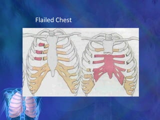Flailed Chest
 