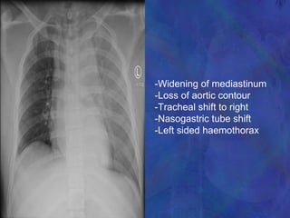 -Widening of mediastinum
-Loss of aortic contour
-Tracheal shift to right
-Nasogastric tube shift
-Left sided haemothorax
 