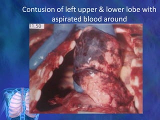 Contusion of left upper & lower lobe with
aspirated blood around
 