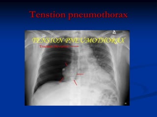 Tenstion pneumothorax
 