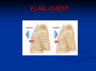 FLAIL CHEST
 