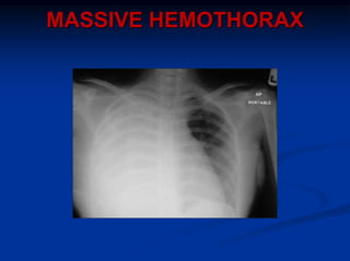 MASSIVE HEMOTHORAX
 