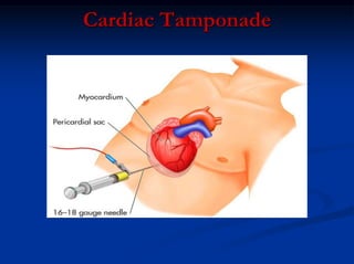 Cardiac Tamponade
 