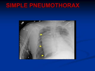 SIMPLE PNEUMOTHORAX
 