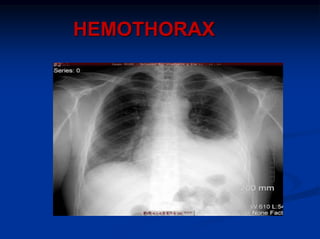 HEMOTHORAX
 