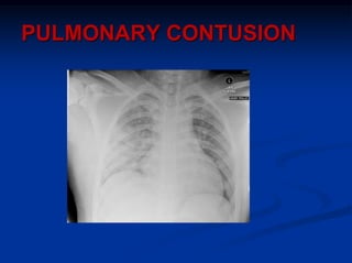 PULMONARY CONTUSION
 