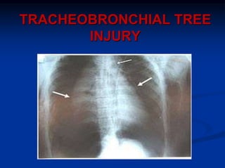 TRACHEOBRONCHIAL TREE
INJURY
 