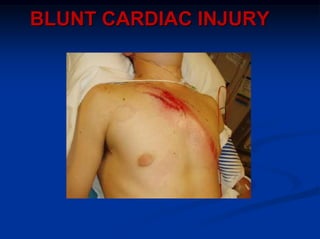 BLUNT CARDIAC INJURY
 