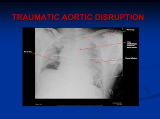 TRAUMATIC AORTIC DISRUPTION
 