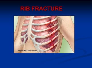 RIB FRACTURE
 