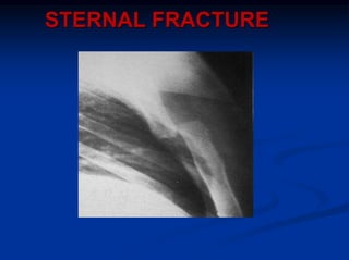 STERNAL FRACTURE
 