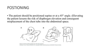 POSTIONING
• The patient should be positioned supine or at a 45° angle. (Elevating
the patient lessens the risk of diaphragm elevation and consequent
misplacement of the chest tube into the abdominal space.
 