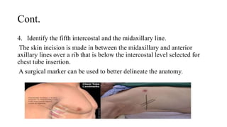 Cont.
4. Identify the fifth intercostal and the midaxillary line.
The skin incision is made in between the midaxillary and anterior
axillary lines over a rib that is below the intercostal level selected for
chest tube insertion.
A surgical marker can be used to better delineate the anatomy.
 