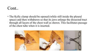 Cont..
 The Kelly clamp should be opened (while still inside the pleural
space) and then withdrawn so that its jaws enlarge the dissected tract
through all layers of the chest wall as shown. This facilitates passage
of the chest tube when it is inserted.
 