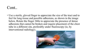 Cont..
 Use a sterile, gloved finger to appreciate the size of the tract and to
feel for lung tissue and possible adhesions, as shown in the image
below. Rotate the finger 360o to appreciate the presence of dense
adhesions that cannot be broken and require placement of the chest
tube in a different site, preferably under fluoroscopy (ie, by
interventional radiology).
 