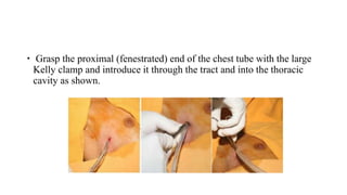  Grasp the proximal (fenestrated) end of the chest tube with the large
Kelly clamp and introduce it through the tract and into the thoracic
cavity as shown.
 