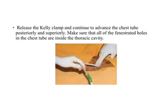  Release the Kelly clamp and continue to advance the chest tube
posteriorly and superiorly. Make sure that all of the fenestrated holes
in the chest tube are inside the thoracic cavity.
 
