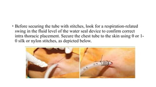  Before securing the tube with stitches, look for a respiration-related
swing in the fluid level of the water seal device to confirm correct
intra thoracic placement. Secure the chest tube to the skin using 0 or 1-
0 silk or nylon stitches, as depicted below.
 