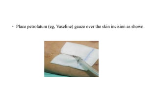  Place petrolatum (eg, Vaseline) gauze over the skin incision as shown.
 