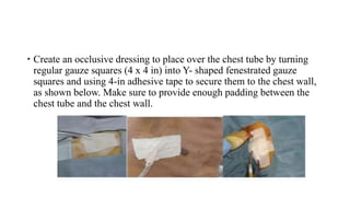  Create an occlusive dressing to place over the chest tube by turning
regular gauze squares (4 x 4 in) into Y- shaped fenestrated gauze
squares and using 4-in adhesive tape to secure them to the chest wall,
as shown below. Make sure to provide enough padding between the
chest tube and the chest wall.
 