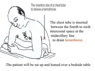 The chest tube is inserted
between the fourth to sixth
intercostal space at the
midaxillary line
to drain hemothorax
.
The patient will be sat up and leaned over a bedside table
.
 