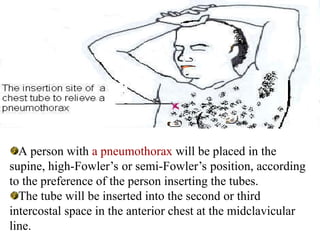 A person with a pneumothorax will be placed in the
supine, high-Fowler’s or semi-Fowler’s position, according
to the preference of the person inserting the tubes.
The tube will be inserted into the second or third
intercostal space in the anterior chest at the midclavicular
line.
 