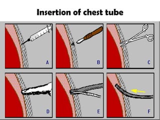 Insertion of chest tube
 