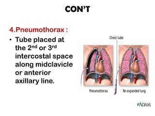 CON’T
4.Pneumothorax :
• Tube placed at
the 2nd or 3rd
intercostal space
along midclavicle
or anterior
axillary line.
 