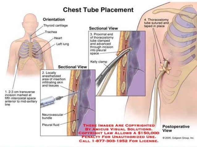 chest tube drainage drtinku joseph 23 638